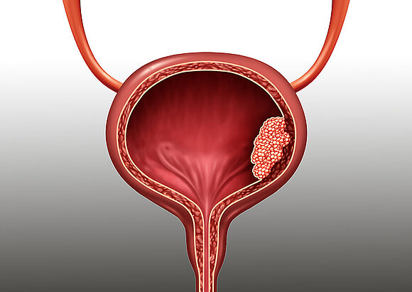 Behandlungsschwerpunkt Harnblasentumor