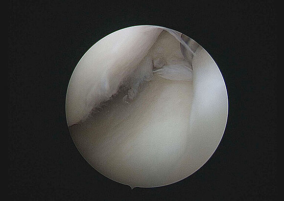 Behandlungsschwerpunkt Knorpelchirurgie