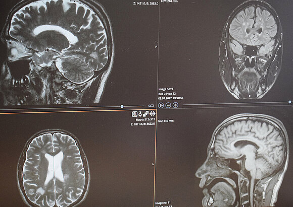 Behandlungsschwerpunkt Multiple Sklerose