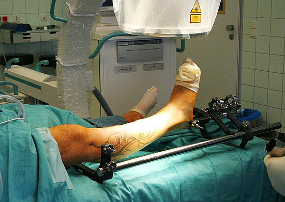Behandlungsschwerpunkt Knochenbruchbehandlung