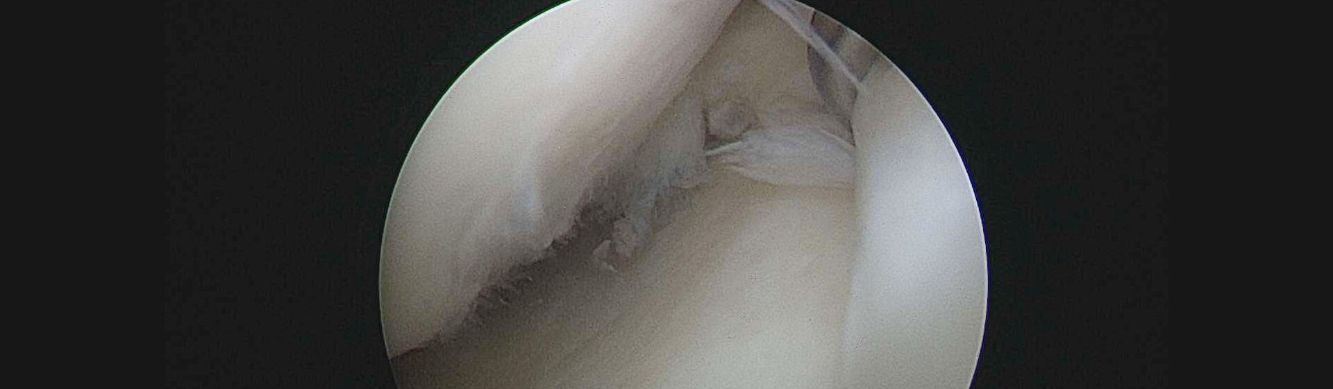 Foto von einer Spiegelung im Inneren eines Gelenkes. Foto von einer Spiegelung im Inneren eines Gelenkes.