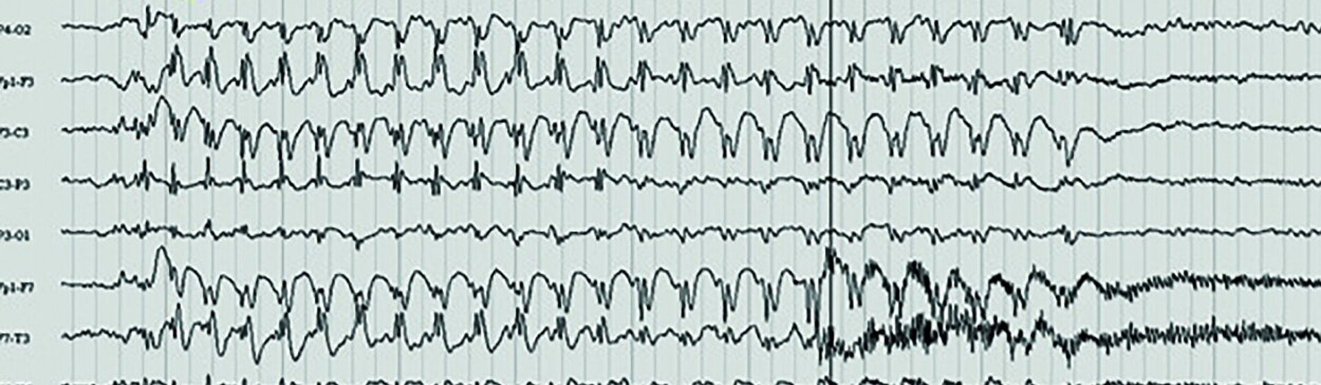 Abbildung eines EEG-Kurvendiagramms.