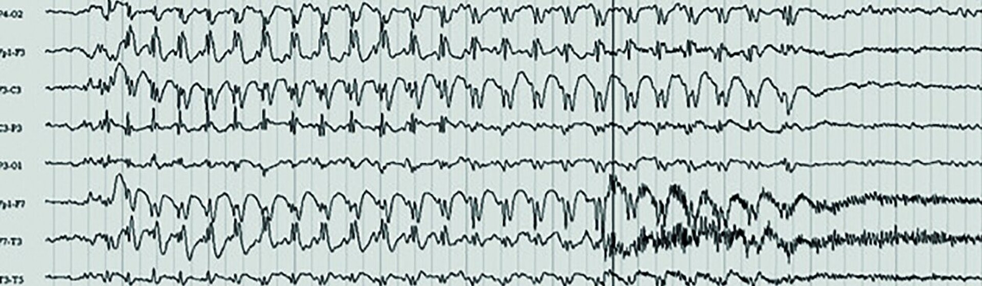 Abbildung eines EEG-Kurvendiagramms. Abbildung eines EEG-Kurvendiagramms.