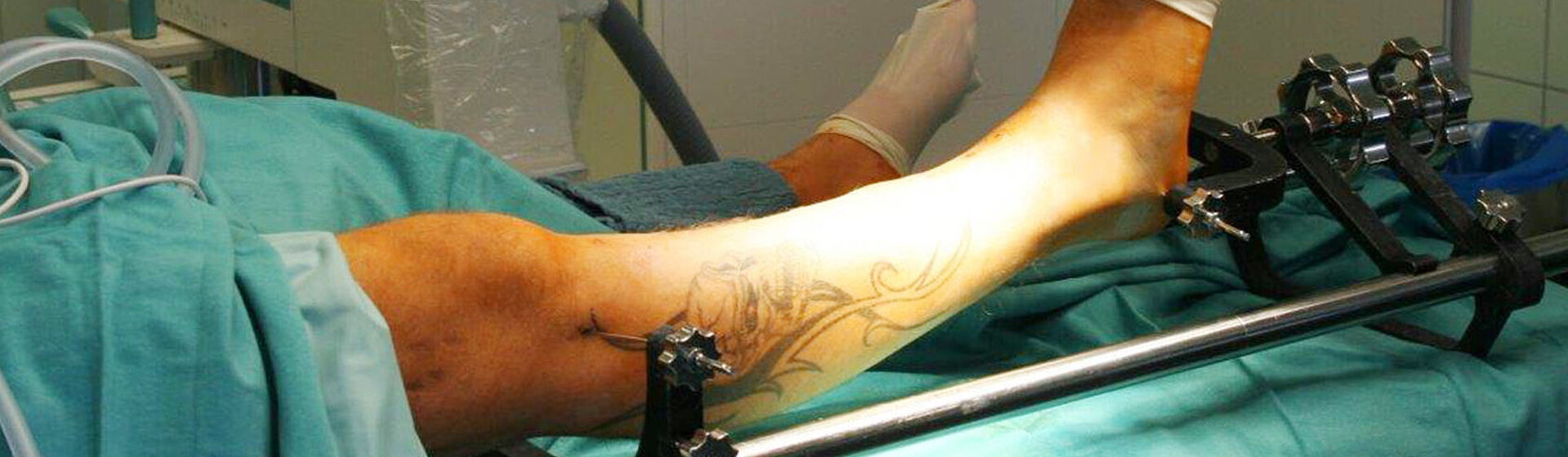 Verletztes Bein im äußeren Festhalter (Fixateur externe).