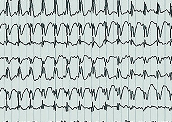 Behandlungsschwerpunkt Epilepsie