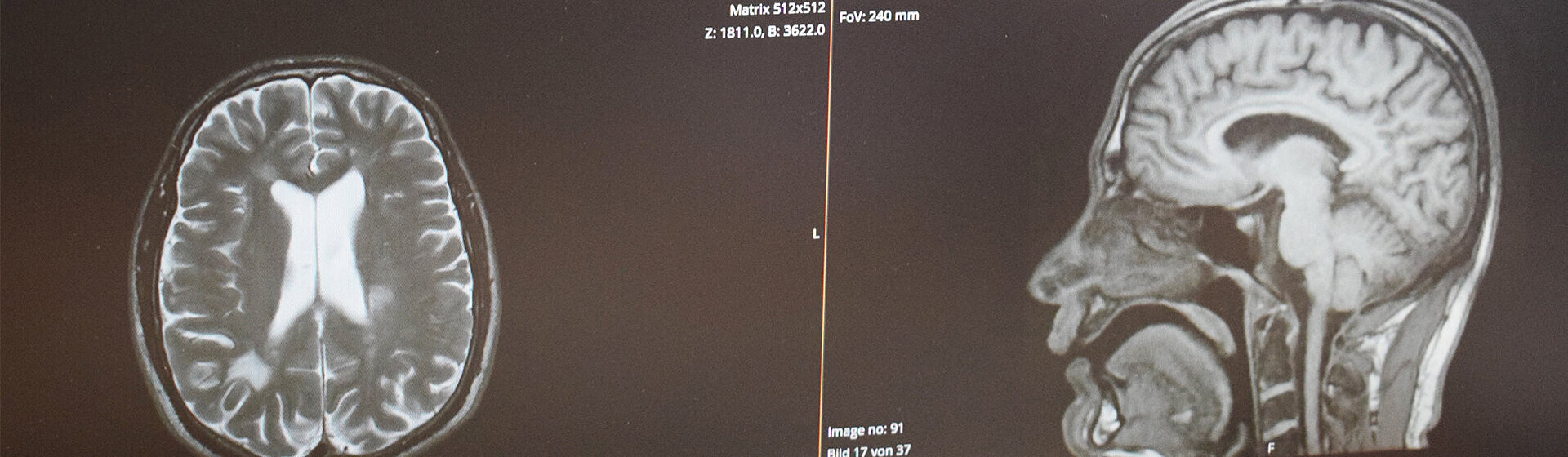 Röntgenbild vom Kopf (Ansichten von oben und von der Seite) Röntgenbild vom Kopf (Ansichten von oben und von der Seite)