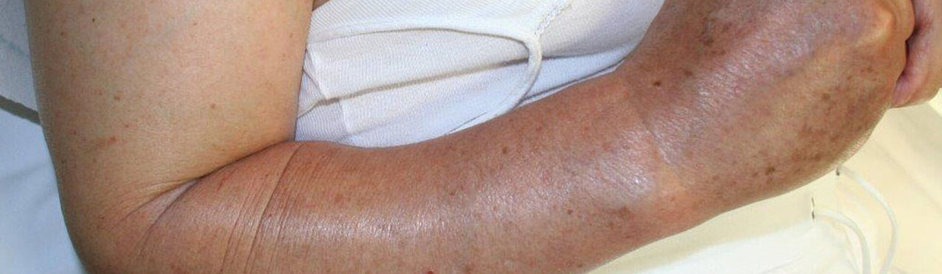 Großaufnahme eines entzündeten Arms. Großaufnahme eines entzündeten Arms.