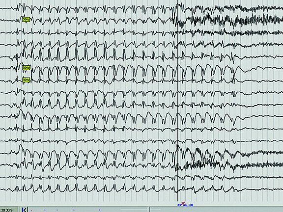 Abbildung eines EEG-Kurvendiagramms.