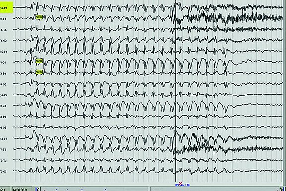 Abbildung eines EEG-Kurvendiagramms.