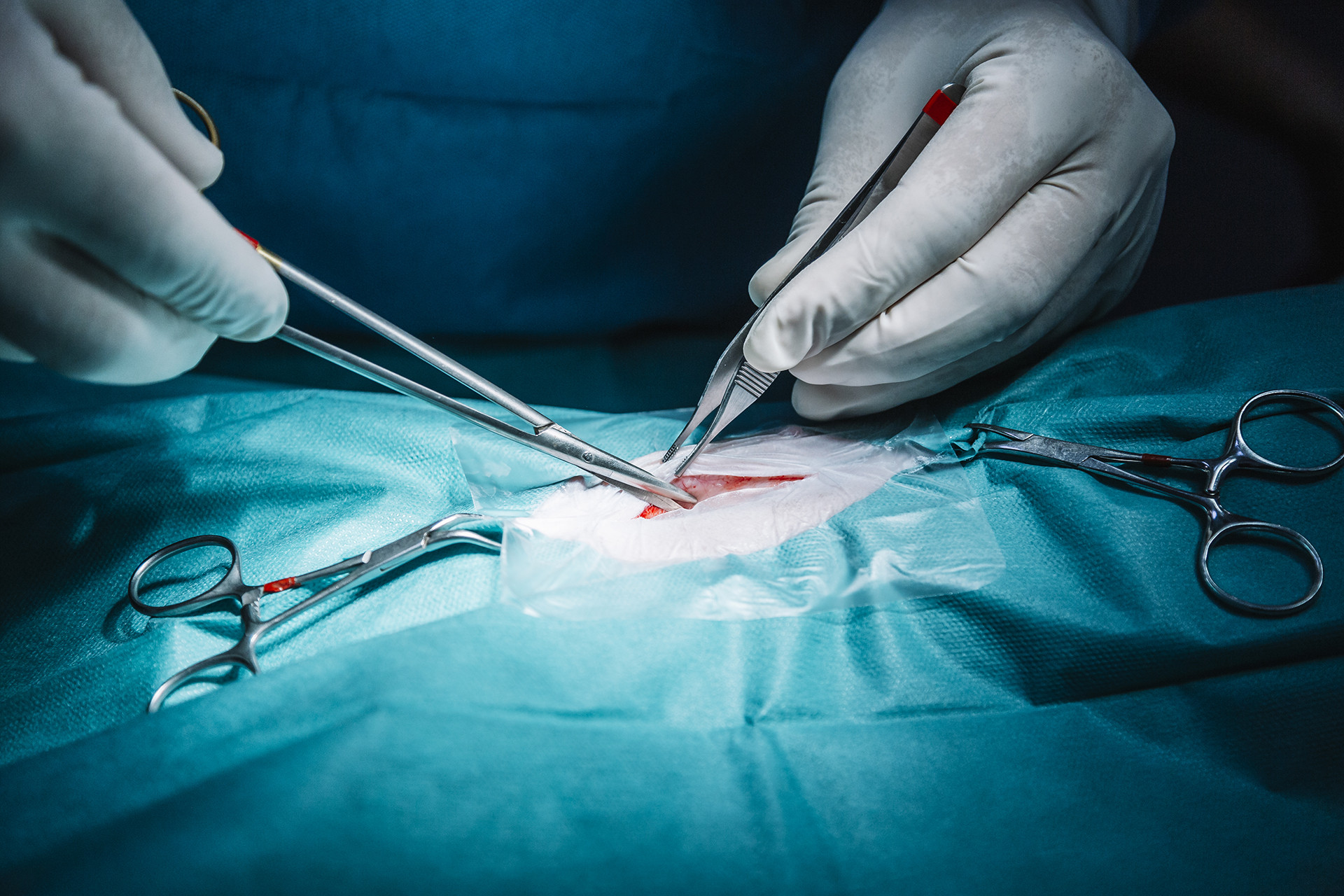 Narbenkorrektur im Operationssaal. Narbenkorrektur im Operationssaal.